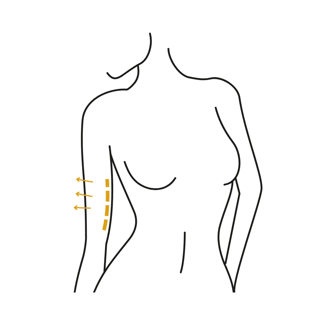 Woman's body illustration highlighting the location of the Armlift surgery