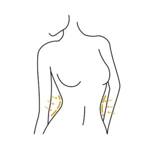 Woman's body illustration highlighting the location of the Body contouring surgery
