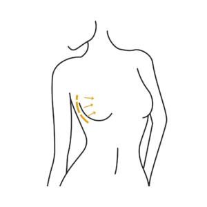 Woman's body illustration highlighting the location of the Breast reduction surgery