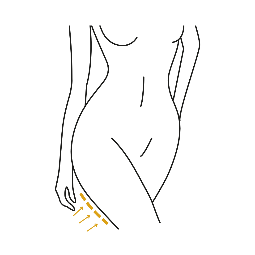 Woman's body illustration highlighting the location of the Thighplasty surgery