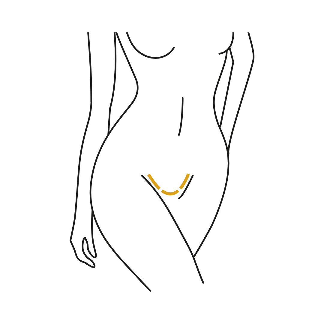 Woman's body illustration highlighting the location of the Vaginoplasty
